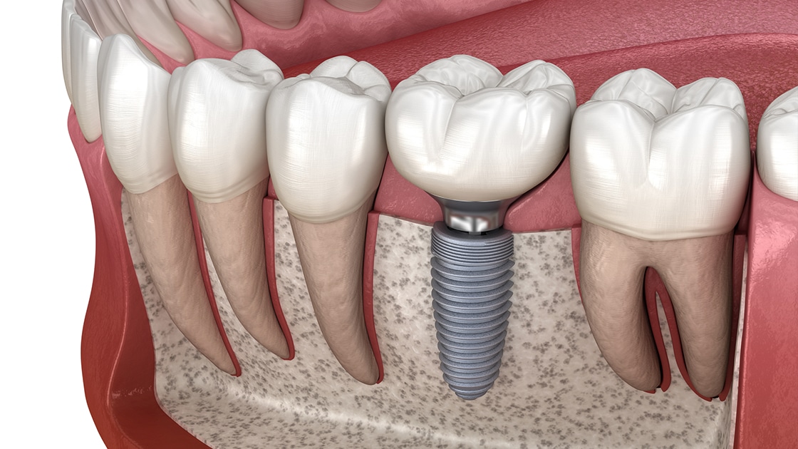 dental implants ashburn va