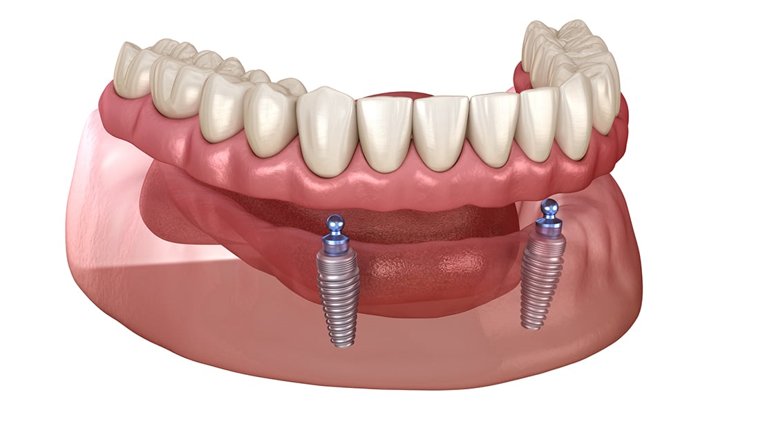 Implant Retained Dentures Graphic